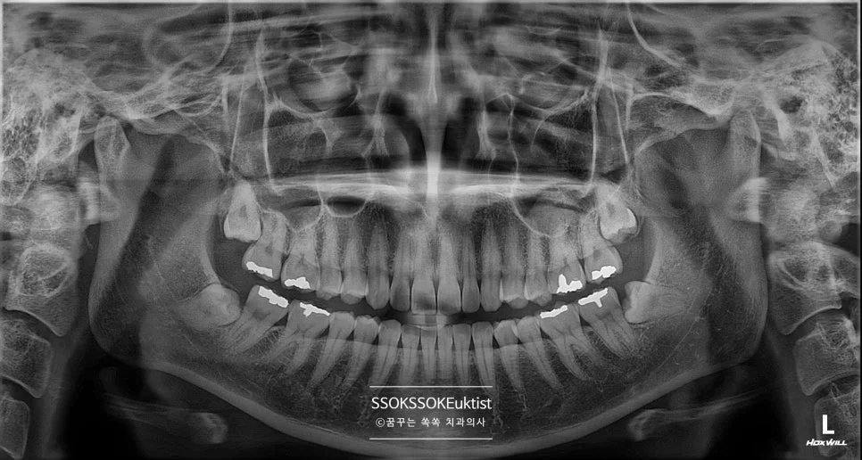 신경치료 케이스1 초진 파노라마 엑스레이
