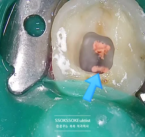 치수 노출 부위 러버댐 사용 시술 중
