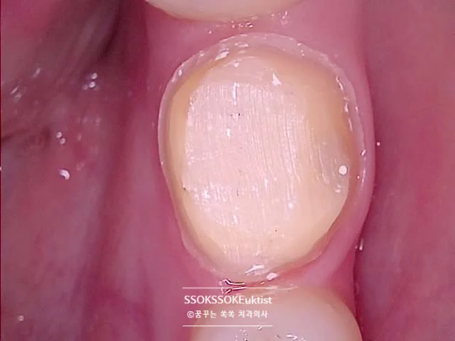 크라운 수복 전 교합면