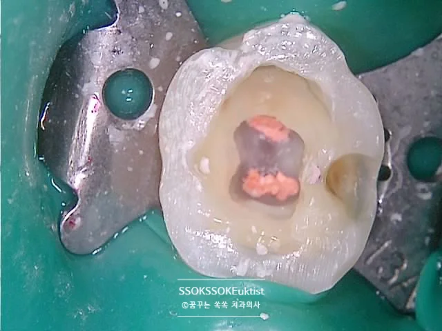 근관 약제 적용 시술 중