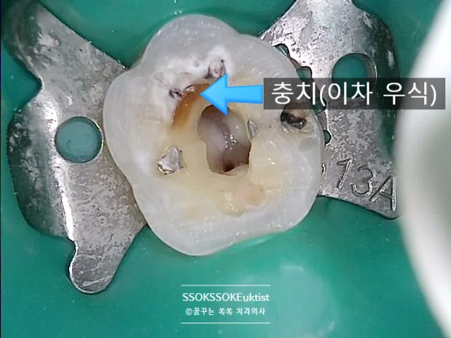 이차 충치 확인 시술 중