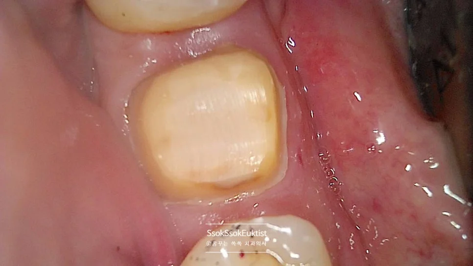 신경치료 후 코어 수복 크라운 준비