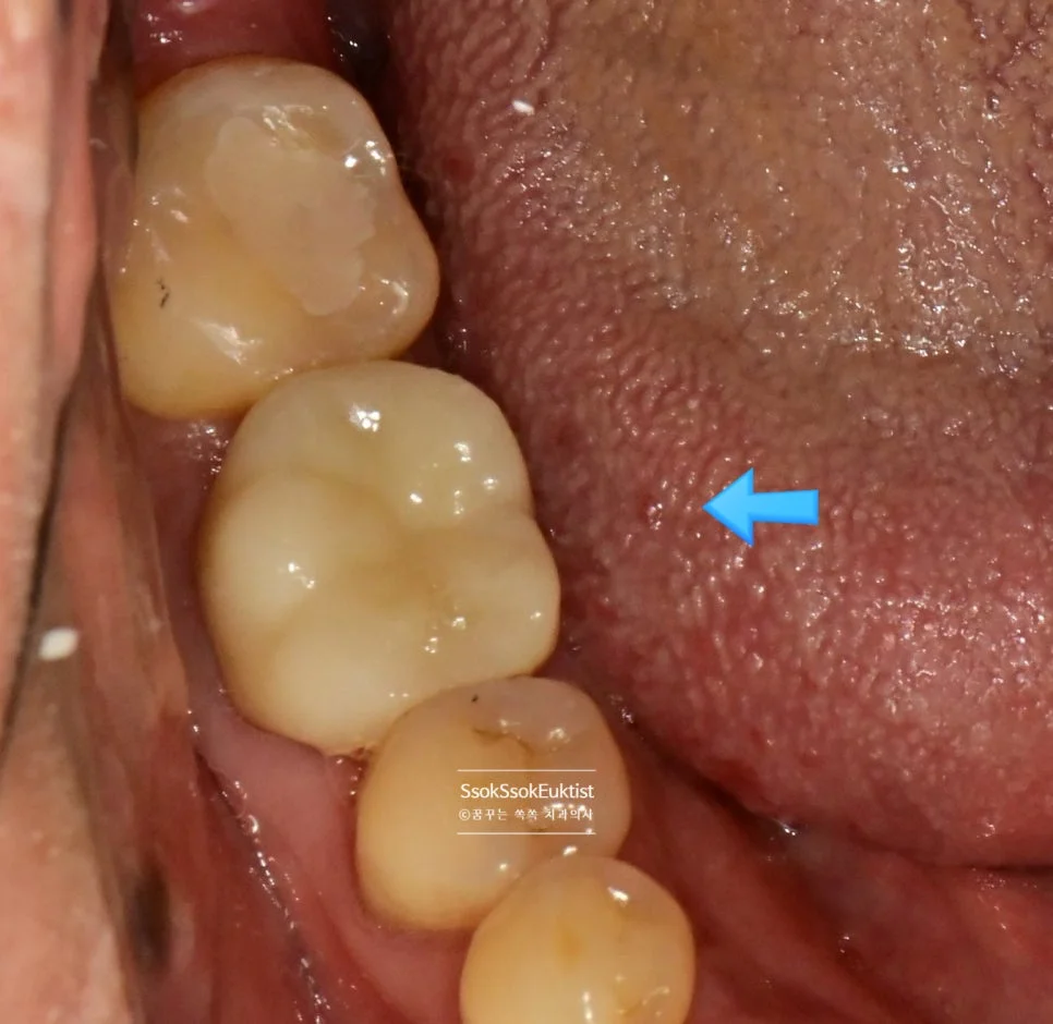 신경치료 후 최종 크라운 장착 완료