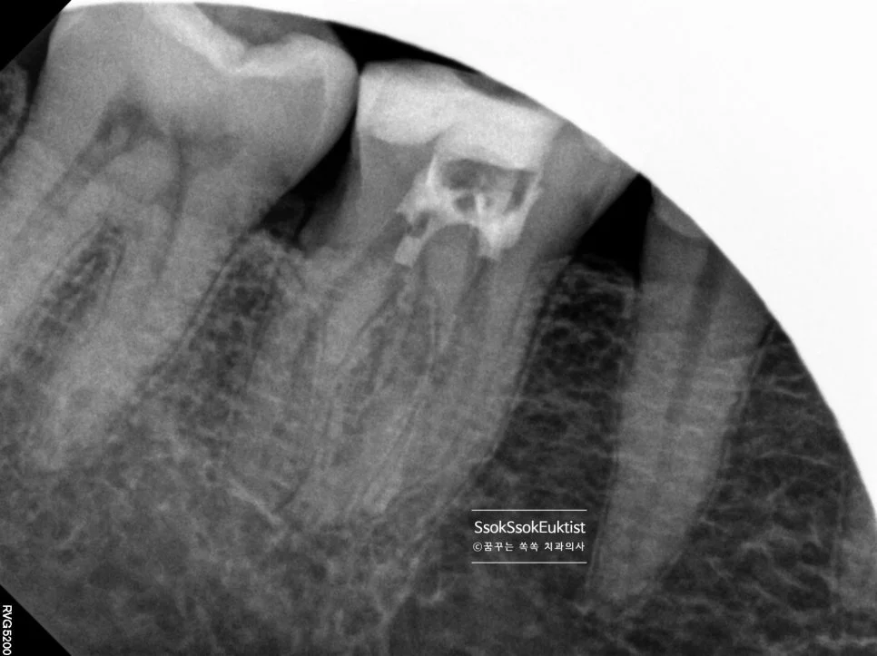 신경치료 치근단 X-ray 크라운 하방 깊은 충치 치수 근접