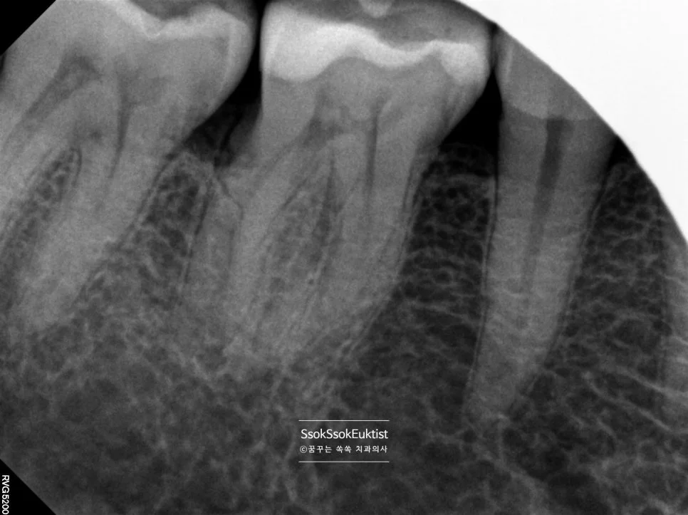 신경치료 치근단 X-ray 충치 신경 근접 진단