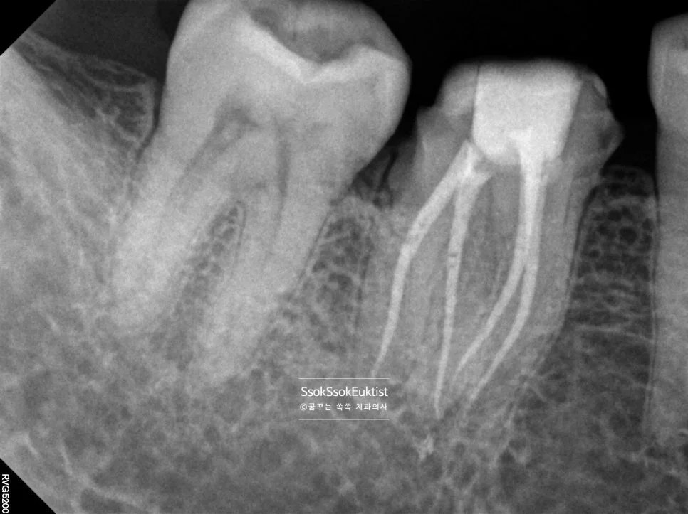 신경치료 완료 치근단 X-ray 근관충전 결과