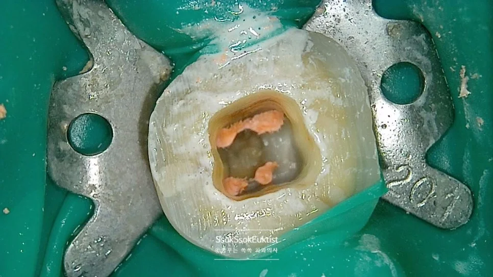 신경치료 러버댐 격리 근관 입구 개방 시술 중