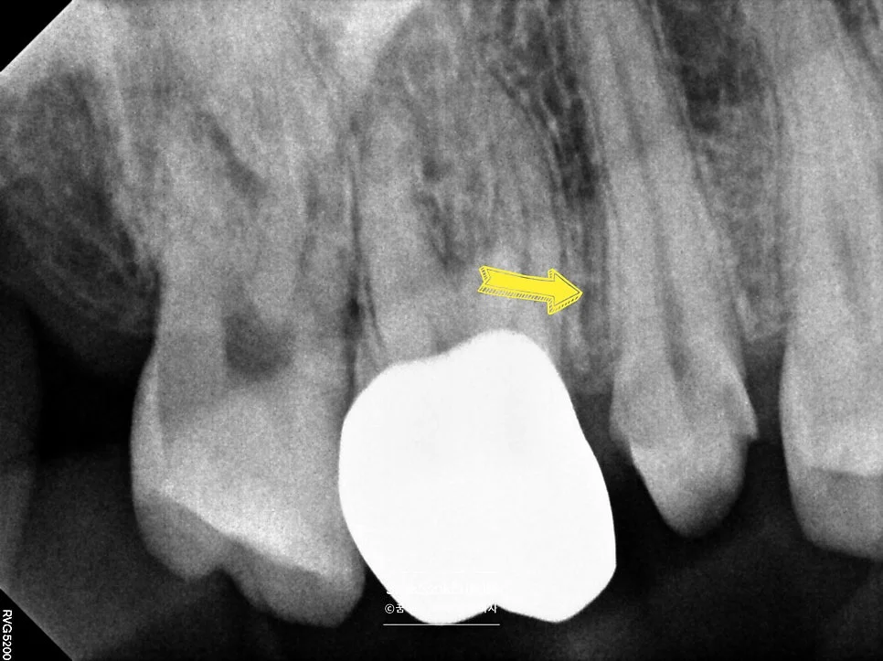 신경치료 중 방사선 사진