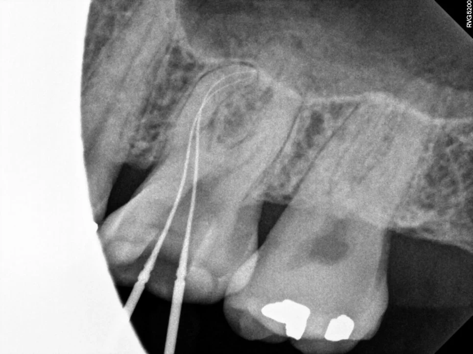 러버댐 장착 후 근관 입구 확보 사진
