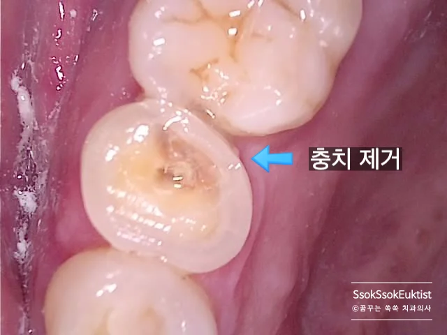 신경치료 격리막 러버댐 장착 후 시술 준비