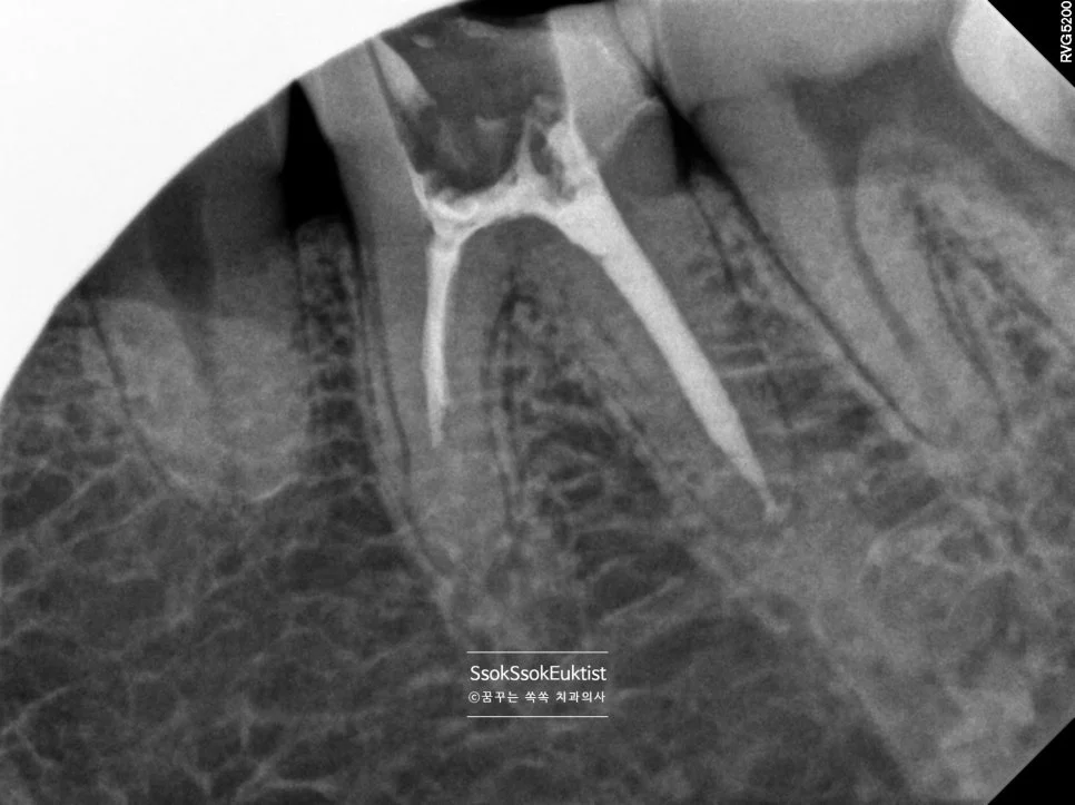 발치 판정 치아 신경치료 완료 근관충전 X-ray