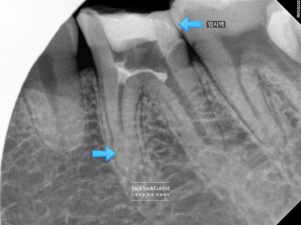 신경치료 중 근관장 측정 X-ray 임시벽 및 막힌 신경관 화살표