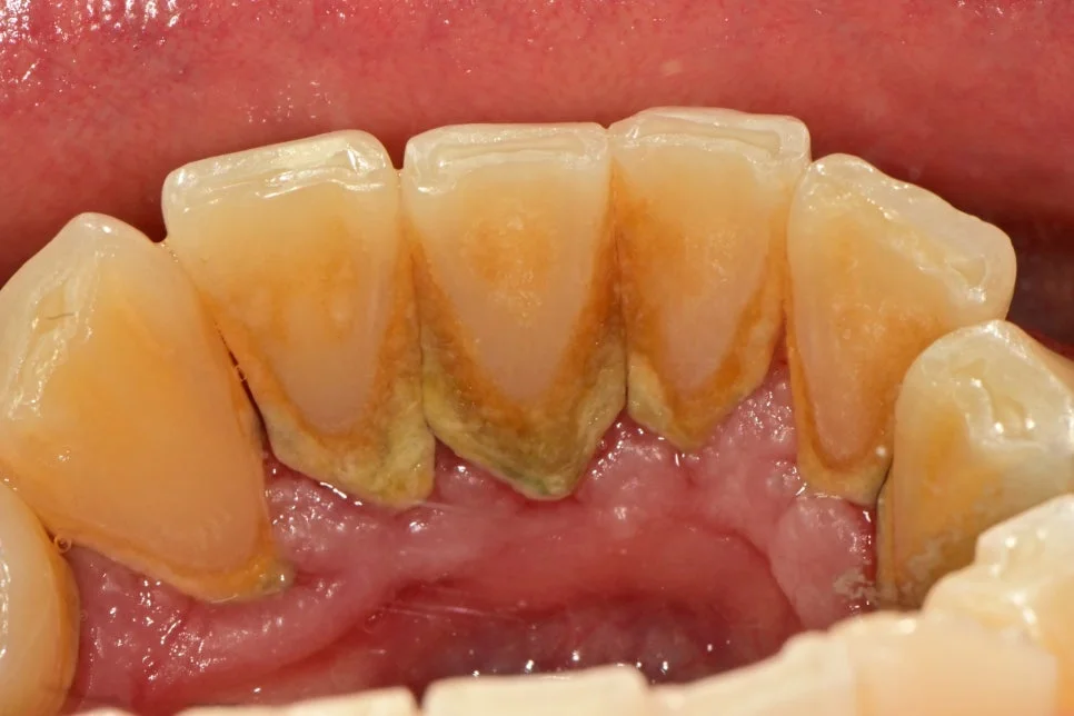 스케일링 전 잇몸 염증 상태 임상 사진