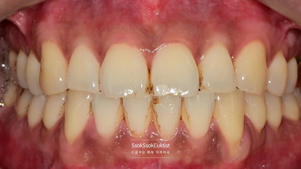 스케일링 전 검은색 착색 치아 표면 증례2
