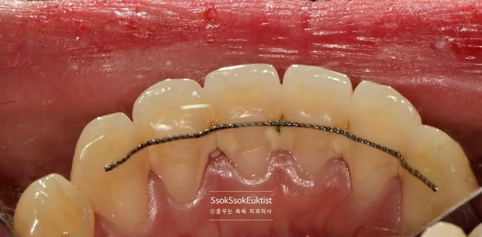 하악 전치부 치석 제거 후 기록 사진 증례3