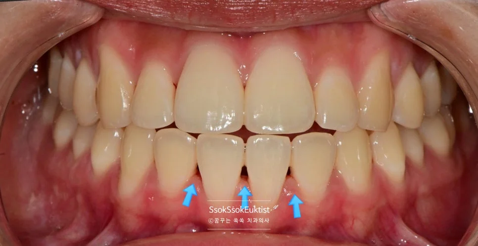 잇몸 하방 치석 진단 상세 사진 증례3