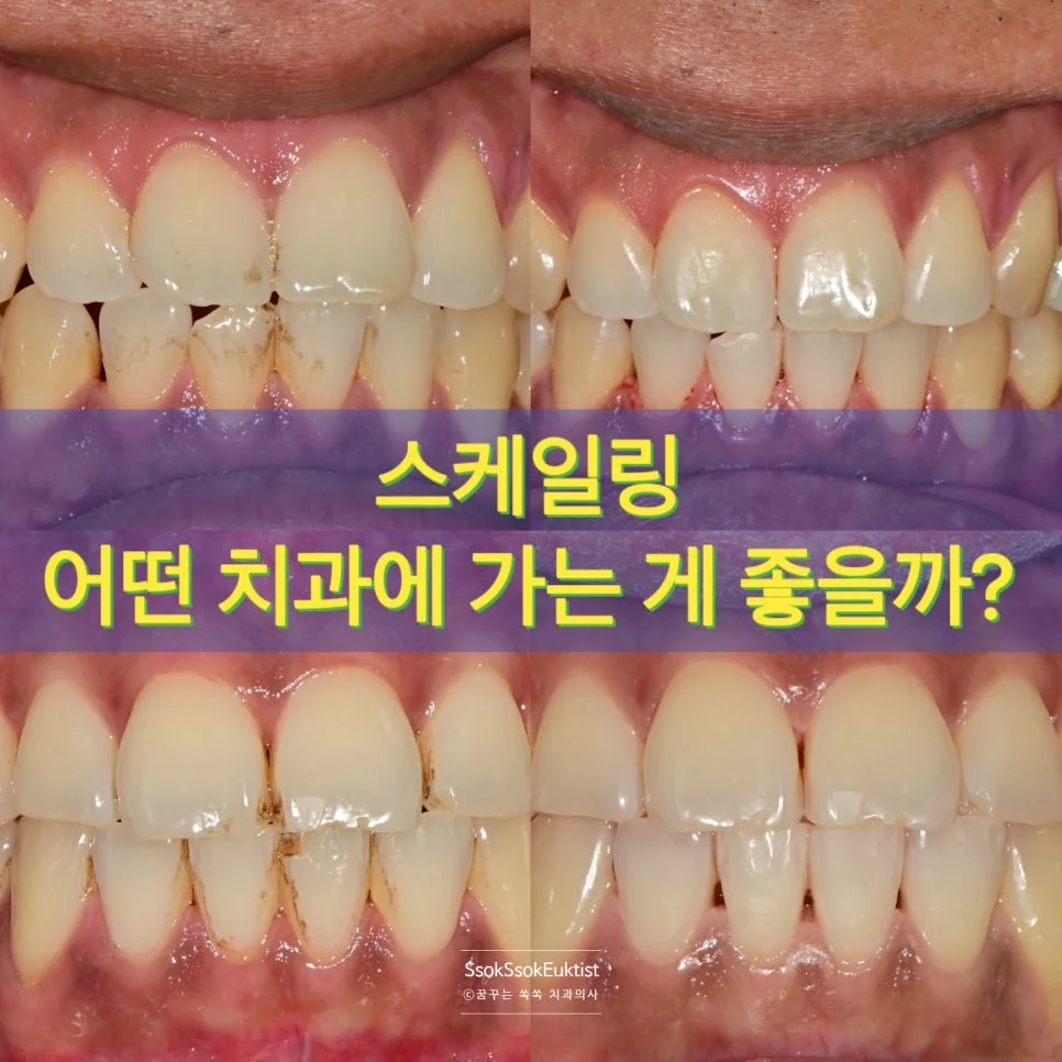 스케일링 착색제거 전후 비교 타이틀 이미지