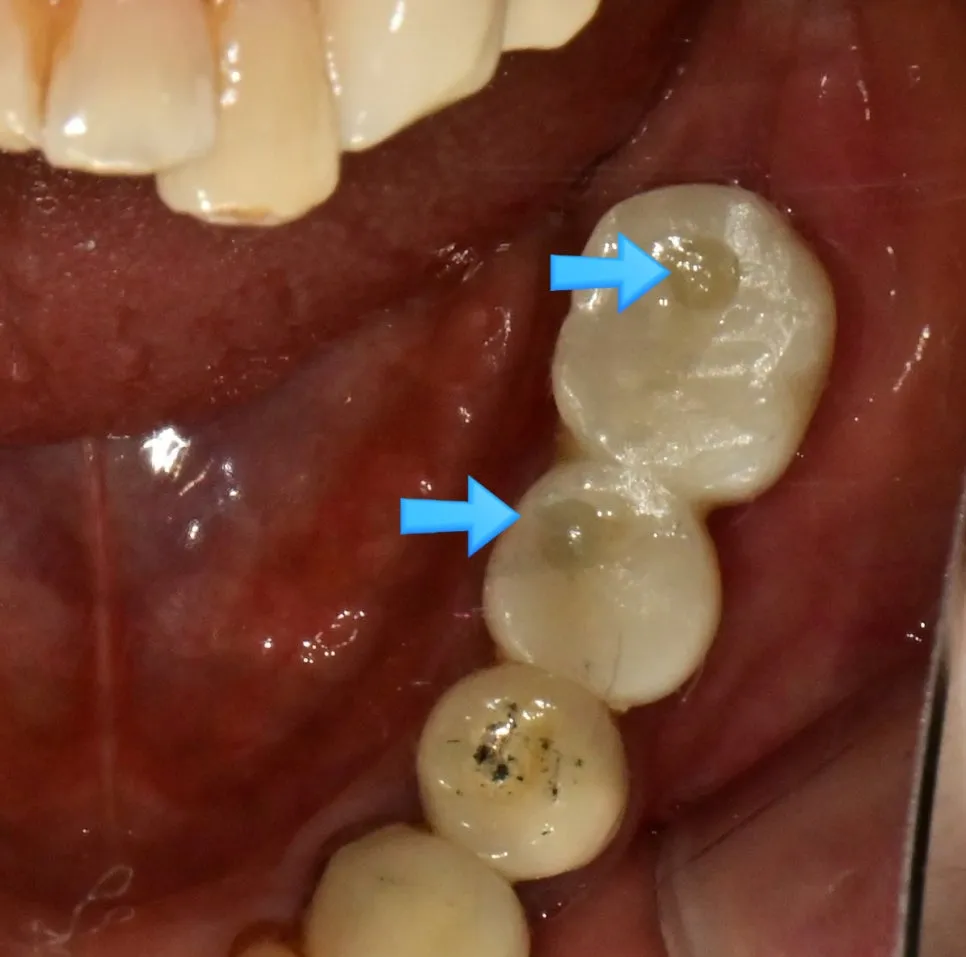 SCRP 보철물 최종 장착 후 나사 접근 구멍 확인 구강 사진
