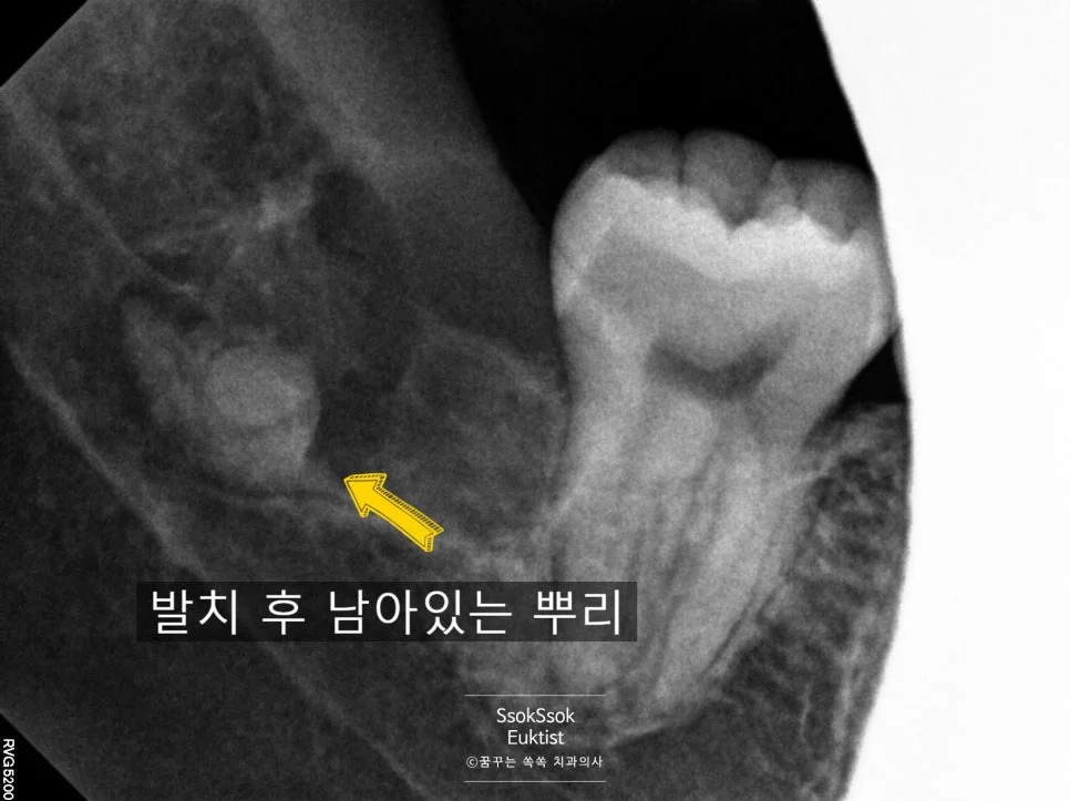 두 번째 수면 발치 후 뿌리 일부 남은 상태