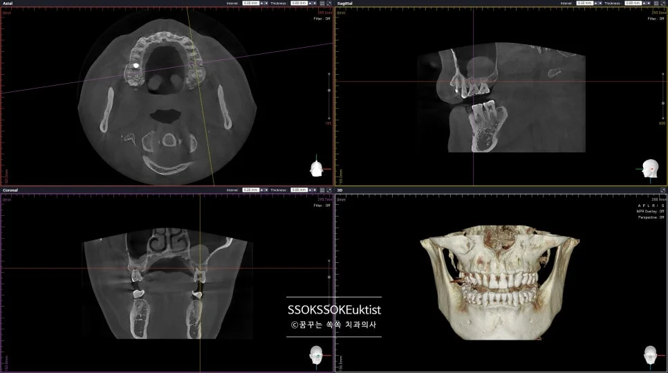 케이스1 CBCT 다축 뷰 상악동 평가