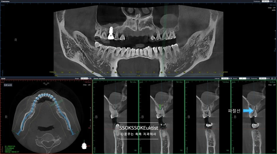 케이스1 CBCT 잔존골 5mm 확인