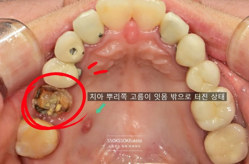 케이스2 뿌리 고름 교합면 사진