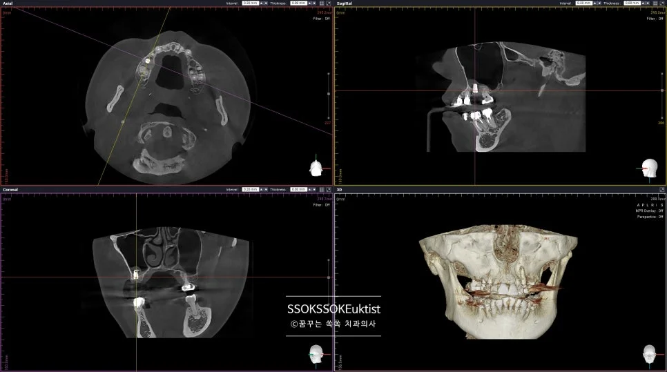 케이스2 임플란트 CBCT 술후 확인