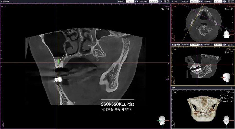 케이스2 CBCT 잔존골 4mm 확인