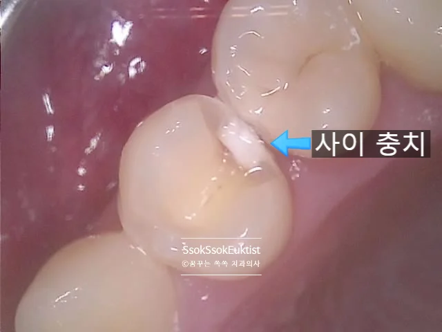 수면 치과 치간 충치 확대 탈회 확인