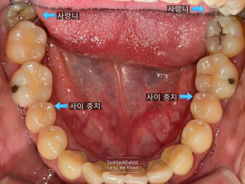 수면 치과 치료 전 하악 교합면 충치 사랑니 표시