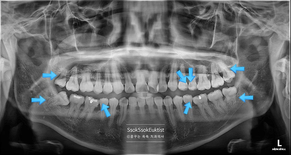 수면 치과 치료 전 파노라마 X-ray 다수 문제 부위 진단