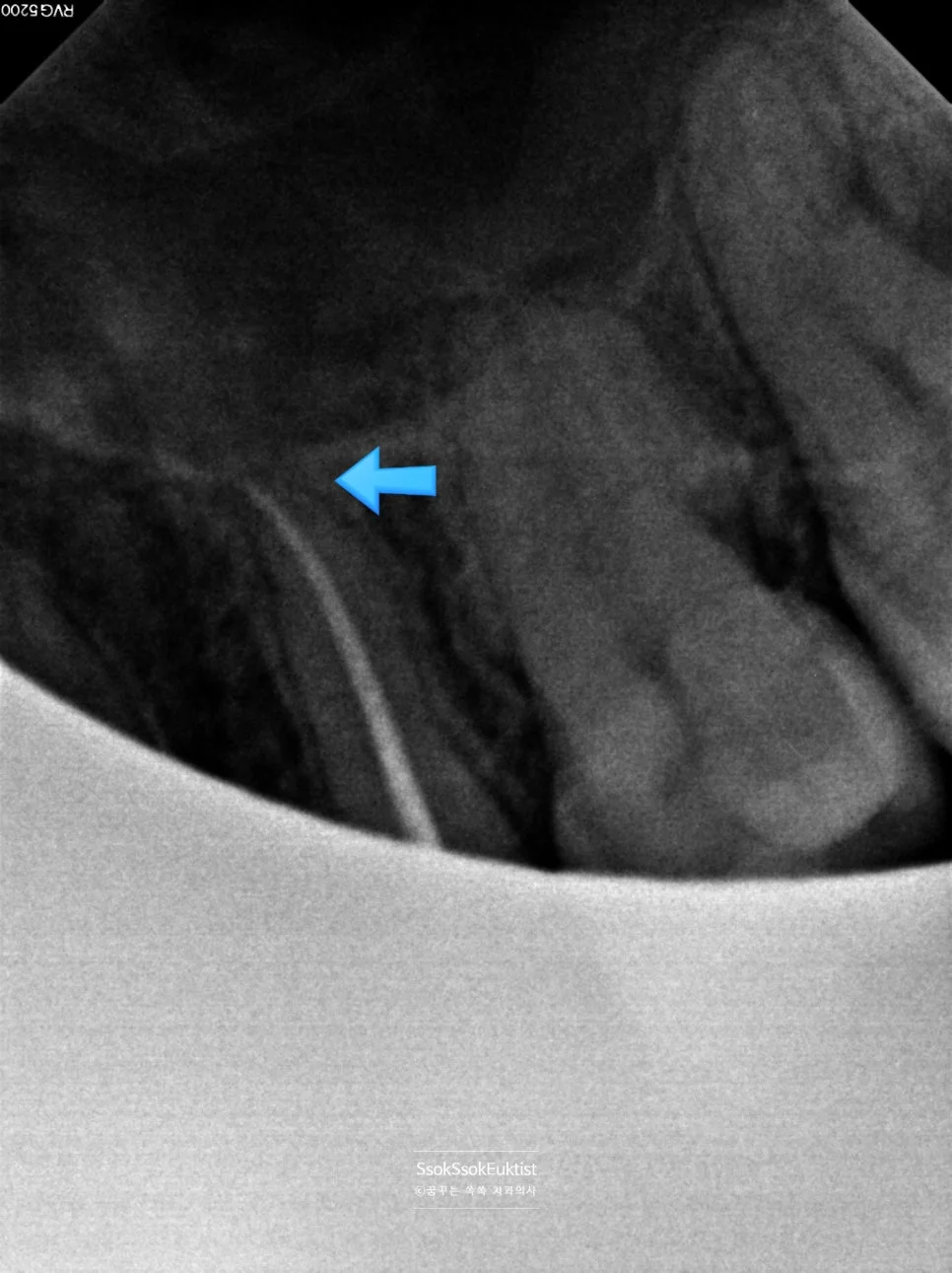 수면 치과 사랑니 치근단 X-ray 진단 1