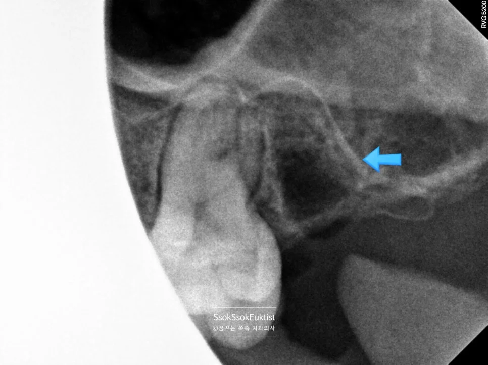 수면 치과 사랑니 치근단 X-ray 진단 2