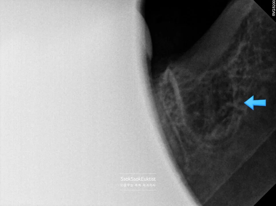 수면 치과 사랑니 치근단 X-ray 낭종 의심