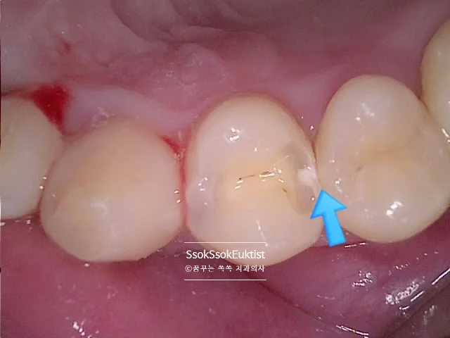 수면 치과 2회차 충치 제거 시술 중 1