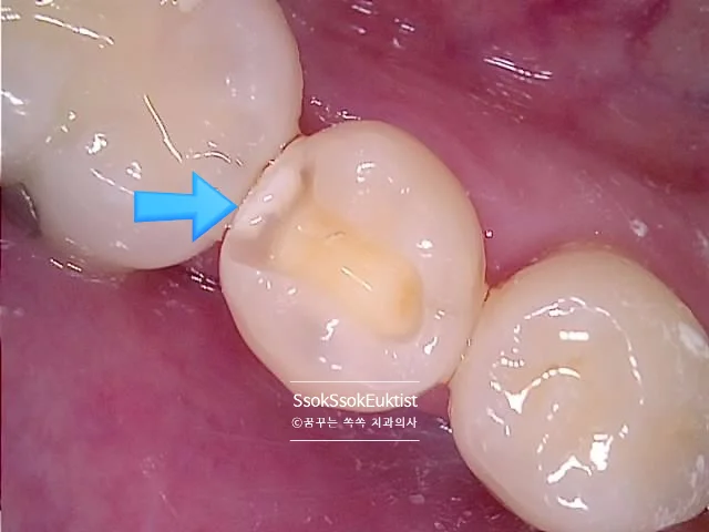 수면 치과 2회차 충치 제거 시술 중 2