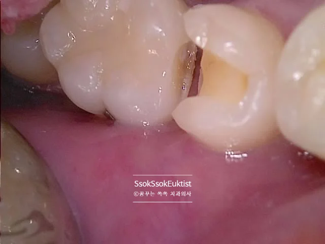 수면 치과 2회차 충치 제거 시술 중 3
