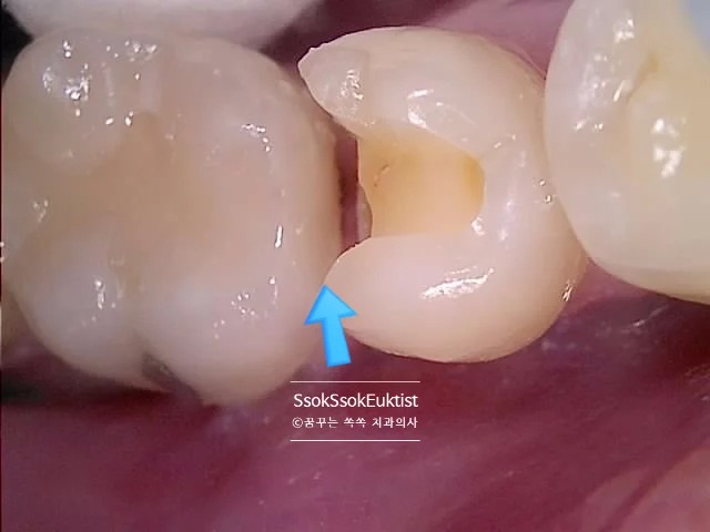 수면 치과 2회차 충치 제거 인접면 확인