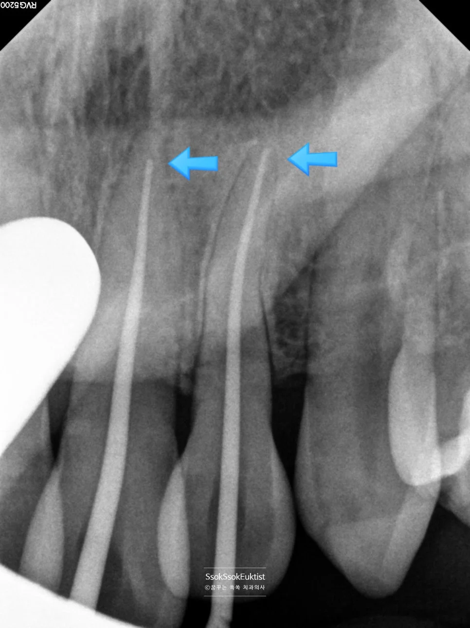 수면 치과 3회차 앞니 신경치료 X-ray 기록