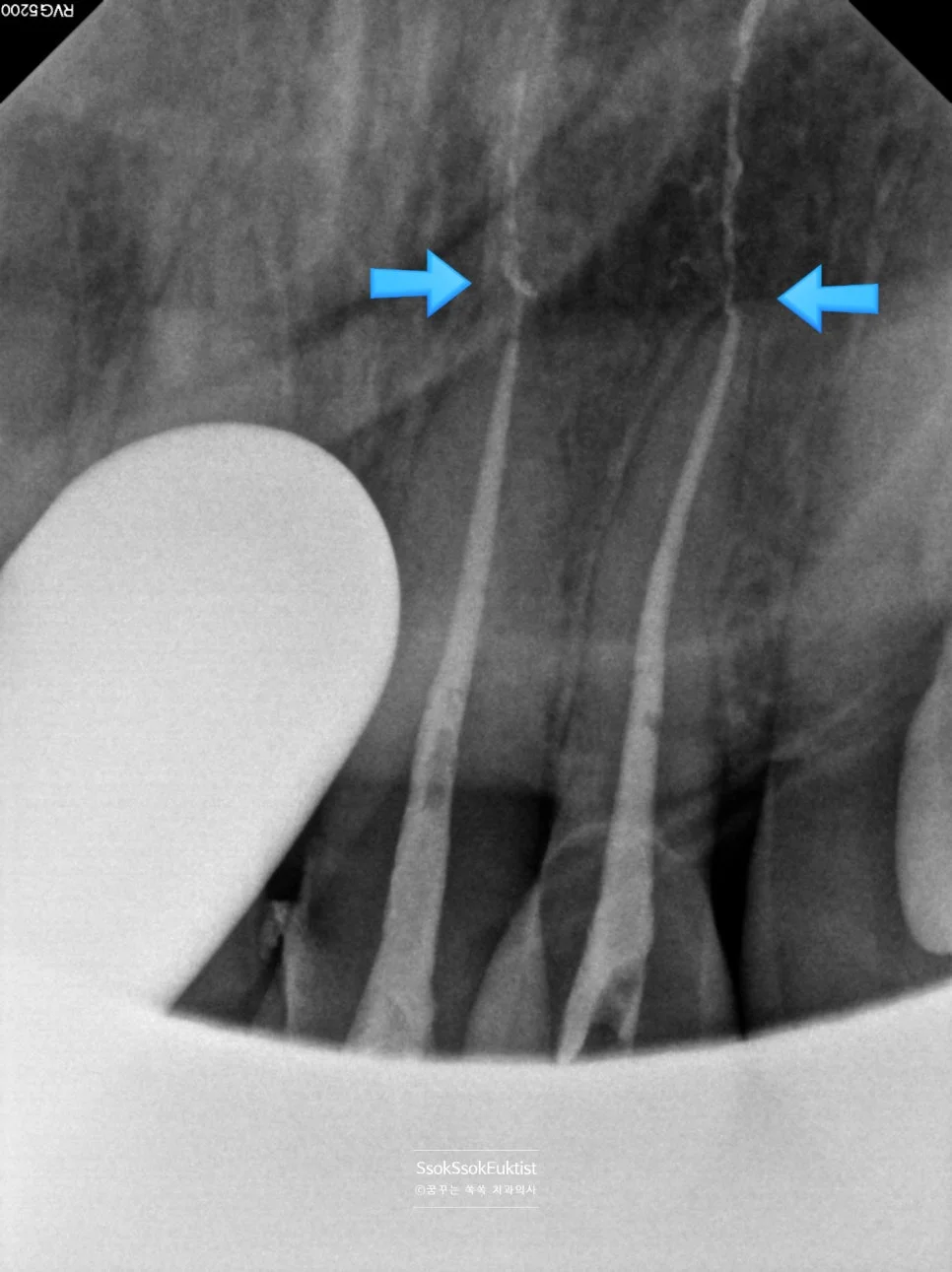수면 치과 3회차 신경치료 완료 근관충전 X-ray