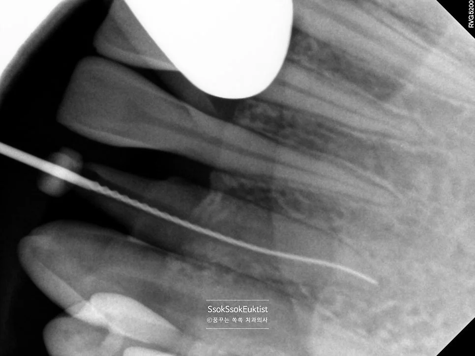 수면 치과 4회차 아래 앞니 신경치료 X-ray