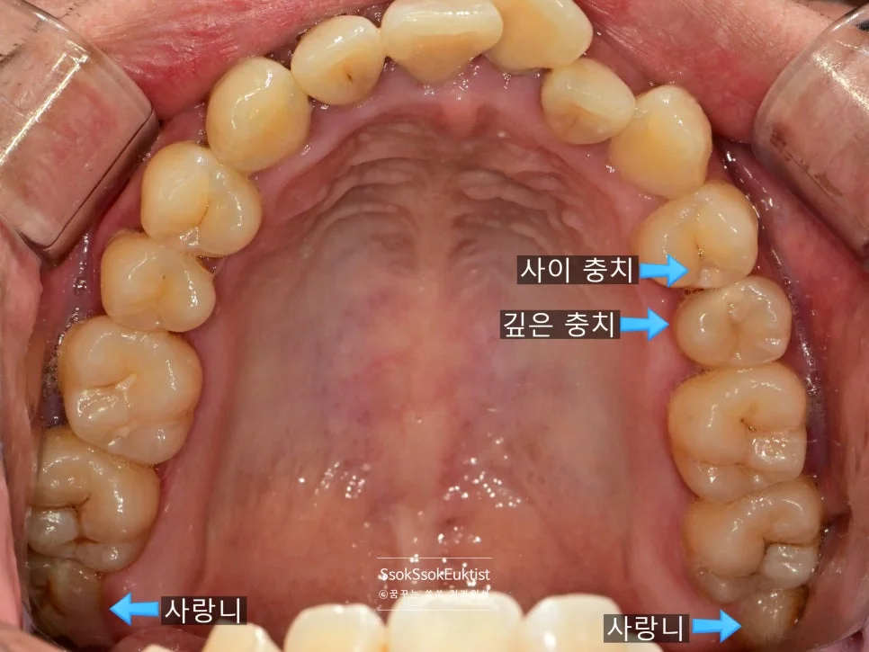 수면 치과 치료 전 상악 교합면 충치 사랑니 표시