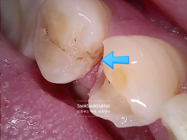 수면 마취 1차 시술 인접 치아 옆면 충치 화살표 표시