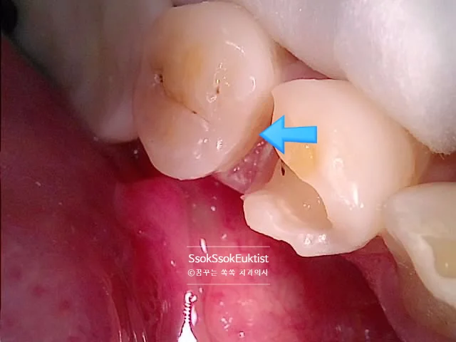 수면 마취 1차 시술 치아 사이 충치 레진 치료 과정