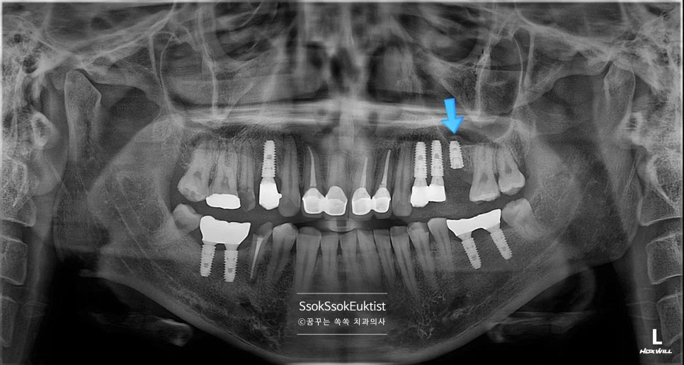 수면 마취 1차 시술 좌측 임플란트 식립 완료 파노라마 X-ray