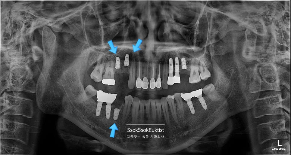 수면 마취 2차 시술 우측 임플란트 3개 식립 완료 파노라마 X-ray 화살표