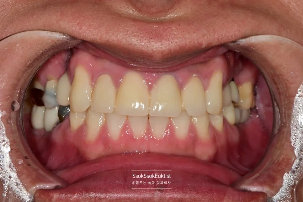 수면 임플란트 치료 전 정면 구내사진 손상된 상악 치아 전체 상태