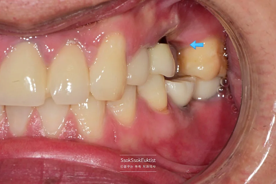 수면 임플란트 치료 전 좌측 측면 사진 충치 화살표 표시
