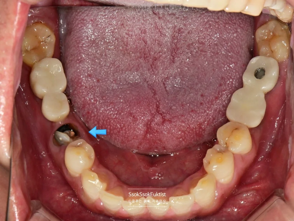 수면 임플란트 치료 전 하악 교합면 사진 임플란트 위치 화살표