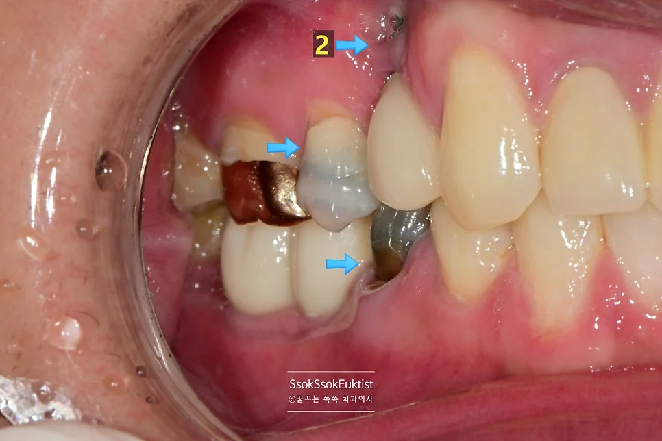 수면 임플란트 치료 전 우측 측면 사진 임플란트 주위염과 충치 화살표 표시